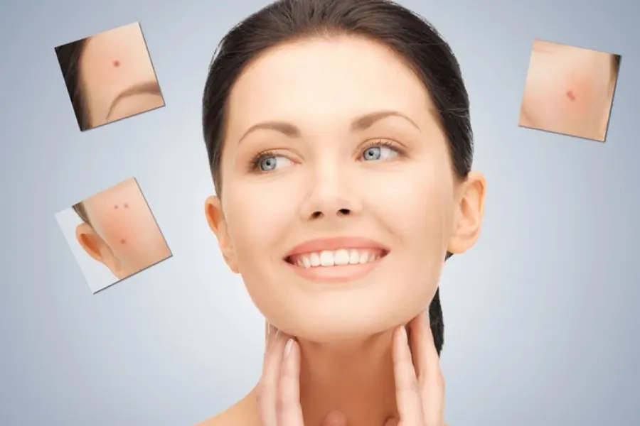 Muối có tính sát khuẩn cao, nhờ đó có thể ngăn ngừa sự hình thành nhân mụn.