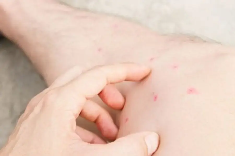 Một số sai lầm phổ biến khiến vết cắn từ bọ chét thêm nặng hơn.