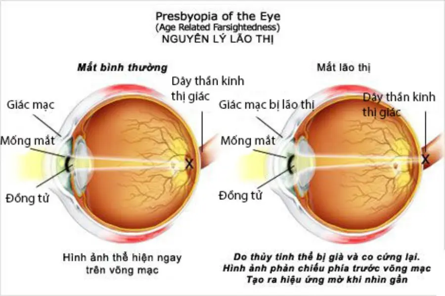 Nguyên lý lcủa tật lão thị