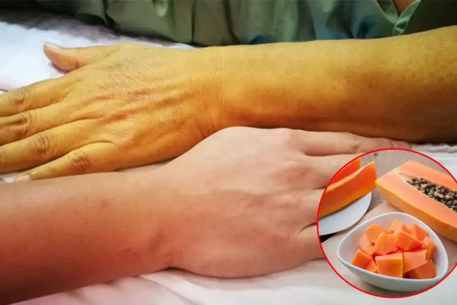 Ăn đu đủ quá nhiều gây vàng da và rối loạn tiêu hóa