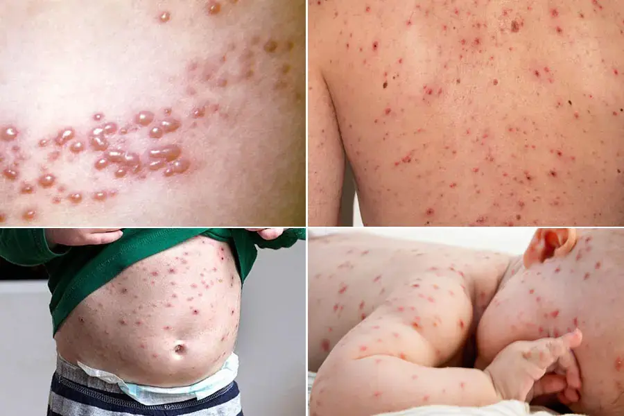 Dấu hiệu trẻ bị bệnh thủy đậu