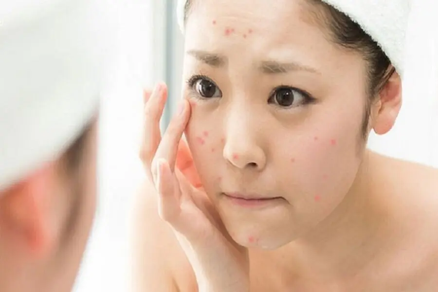 Da sẽ được ngăn ngừa mụn mọc lên nếu được sử dụng nước vo gạo để rửa mặt.