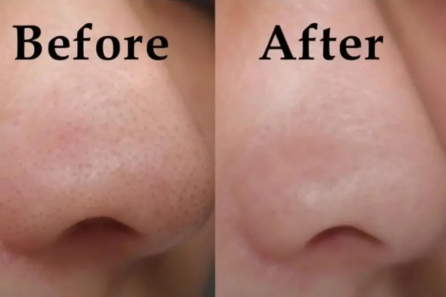 Hình ảnh trước và sau khi trị mụn đầu đen cho mũi.