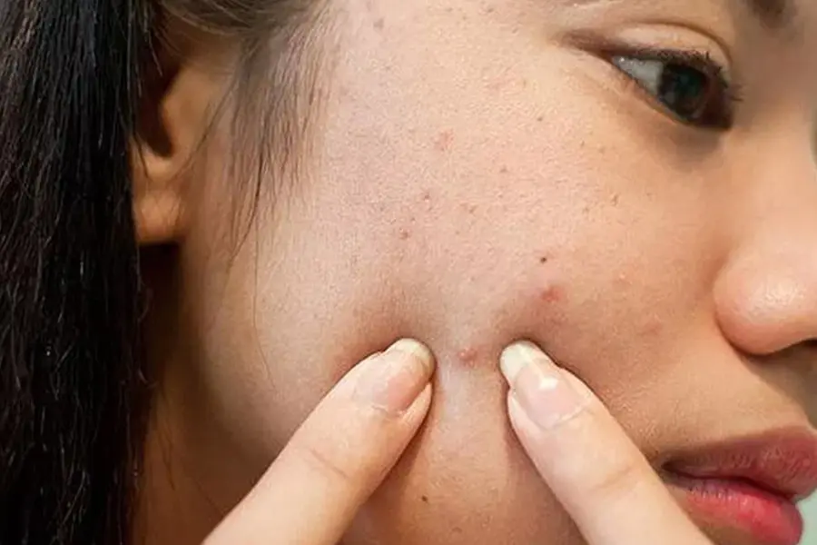 Chạm tay lên mặt hay dùng tay trực tiếp nặn mụn là điều tuyệt đối không nên.