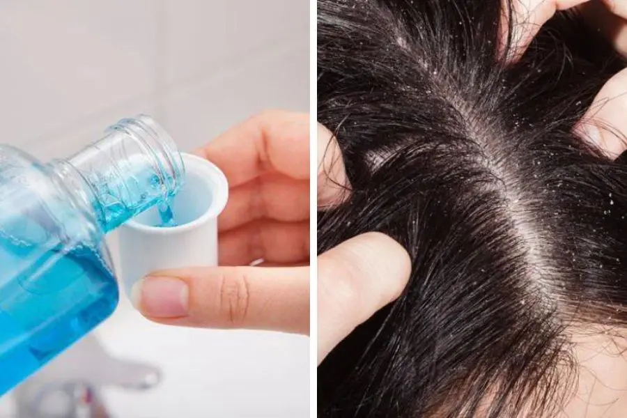 Sử dụng nước súc miệng ủ đầu là một cách trị chấy hiệu quả.
