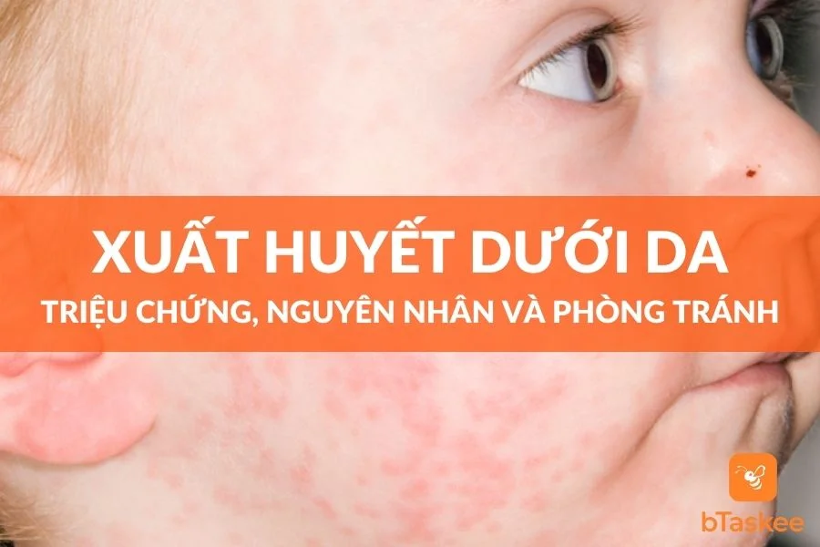 Xuất Huyết Dưới Da - Triệu Chứng, Nguyên Nhân Và Điều Trị