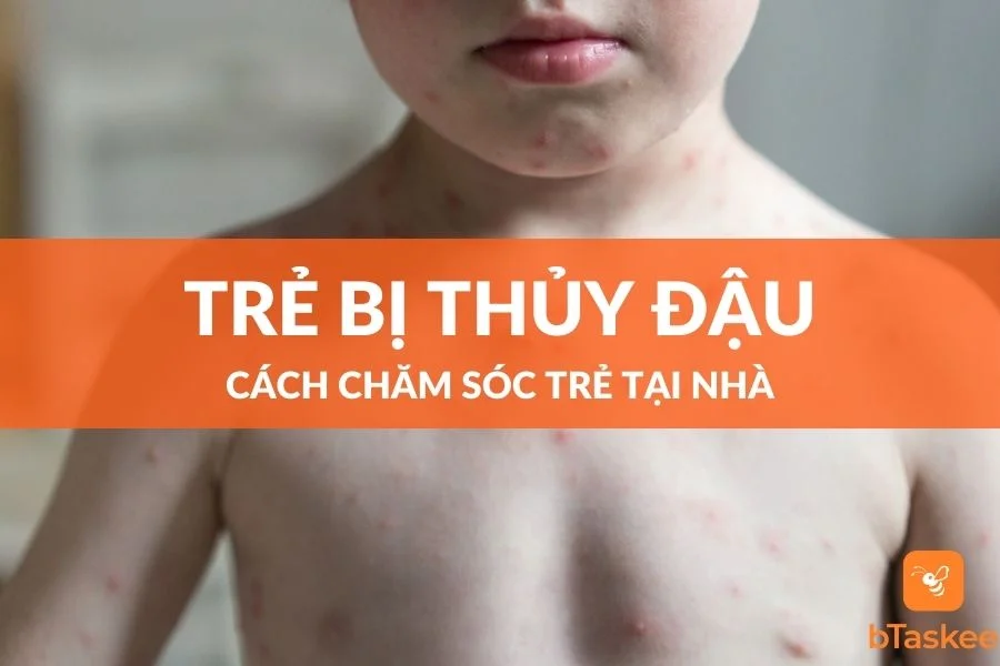 Cách Chăm Sóc Trẻ Bị Thủy Đậu Tại Nhà