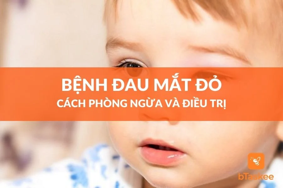 Bệnh Đau Mắt Đỏ, Cách Phòng Ngừa Và Điều Trị