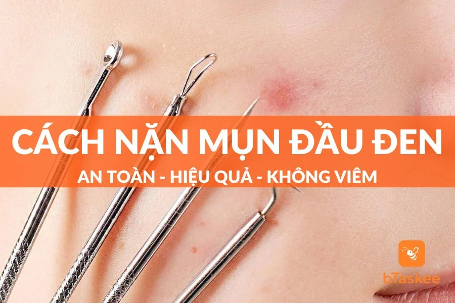Cách Nặn Mụn Đầu Đen An Toàn - Hiệu Quả - Không Viêm