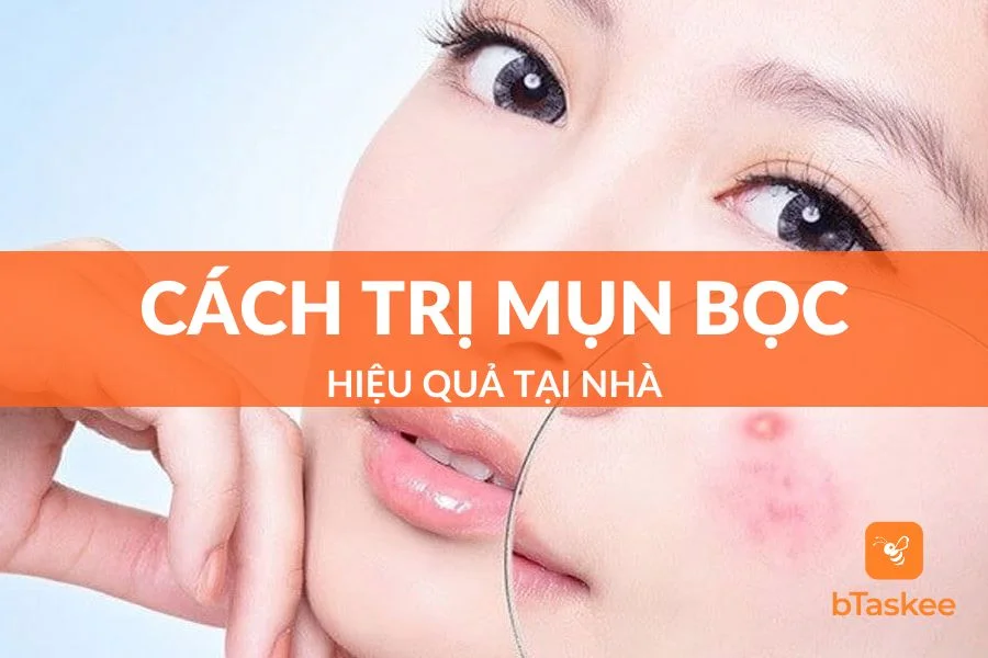 7 Cách Trị Mụn Bọc Tại Nhà Cực Hiệu Quả, Không Để Lại Sẹo